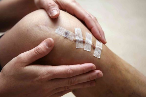 Minh họa tình trạng tụ dịch sau phẫu thuật căng da mặt