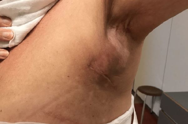 Dấu hiệu sưng cứng bất thường sau khi thực hiện căng da mặt