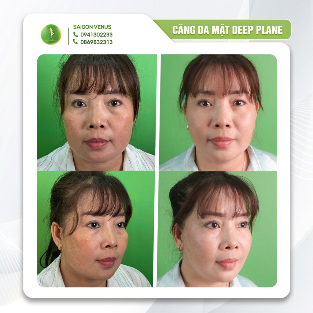 Minh họa cấu trúc giải phóng dây chằng trong kỹ thuật căng da mặt Deep Plane