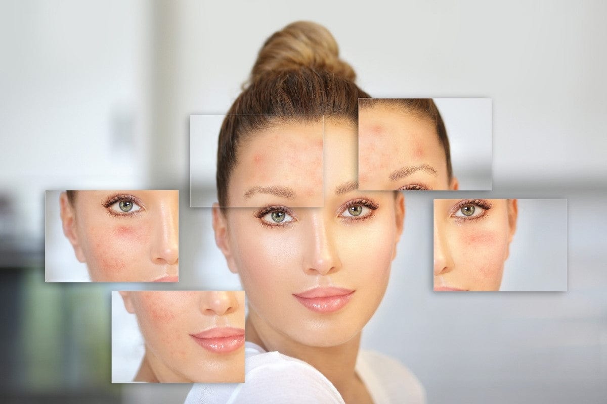 Phục hồi làn da tổn thương sau treatment