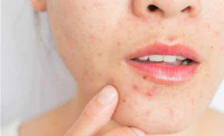 Hình ảnh minh họa về mụn dậy thì ở trẻ em do quy trình làm sạch da chưa phù hợp