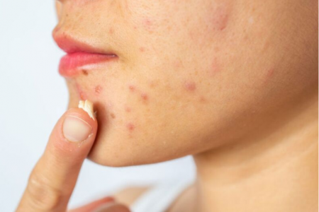 Các nguyên nhân phổ biến dẫn đến mụn ở độ tuổi dậy thì sớm.