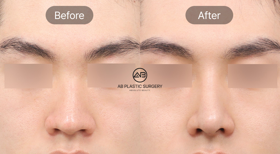 Trước và sau phẫu thuật mũi nam tại Hana Premium Beauty Center