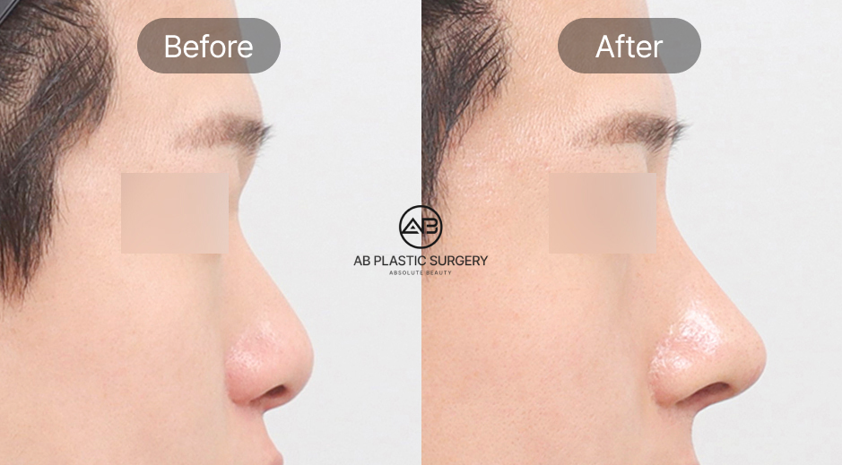 Trước và sau nâng mũi nam Hàn Quốc áp dụng kỹ thuật nâng mũi cấu trúc