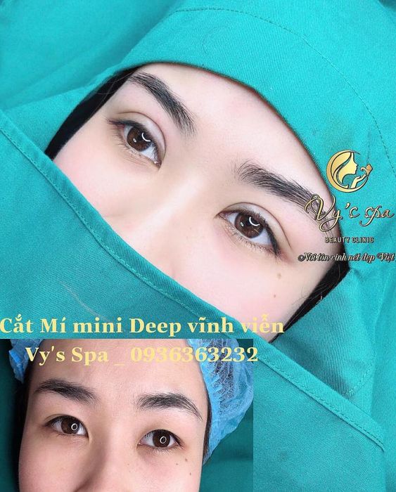 Phân tích chi phí cắt mí an toàn và các yếu tố y khoa liên quan