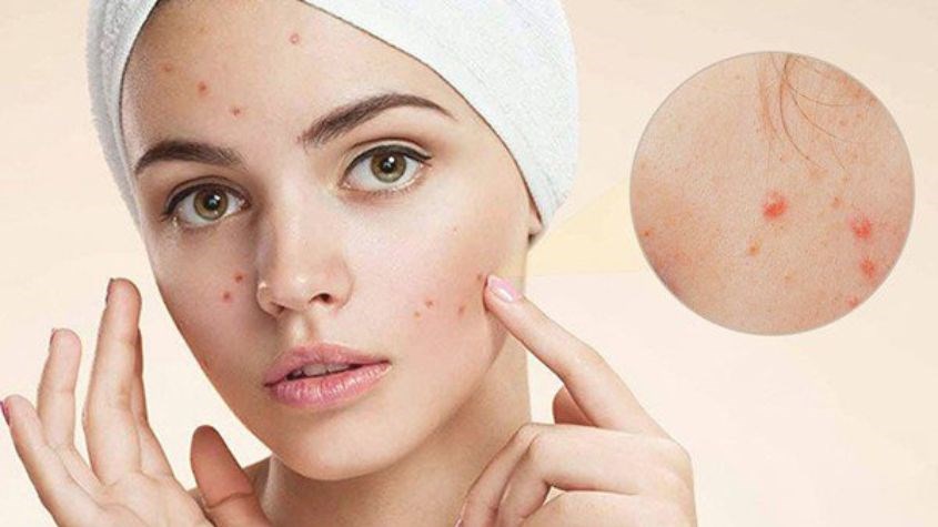 Da mặt nổi mẩn đỏ và bong bóng nhỏ sau khi bôi mỹ phẩm, dấu hiệu da nhạy cảm sau treatment