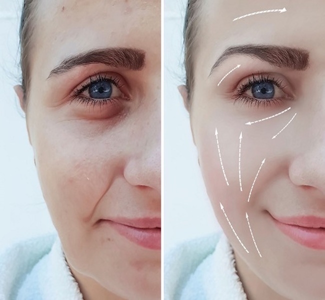 Dấu hiệu nhận biết sớm biến chứng sau khi tiêm filler rãnh cười để can thiệp kịp thời
