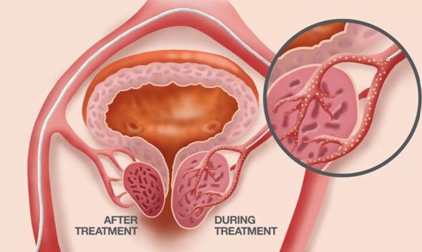 Quá trình hồi phục sau phẫu thuật mí dưới