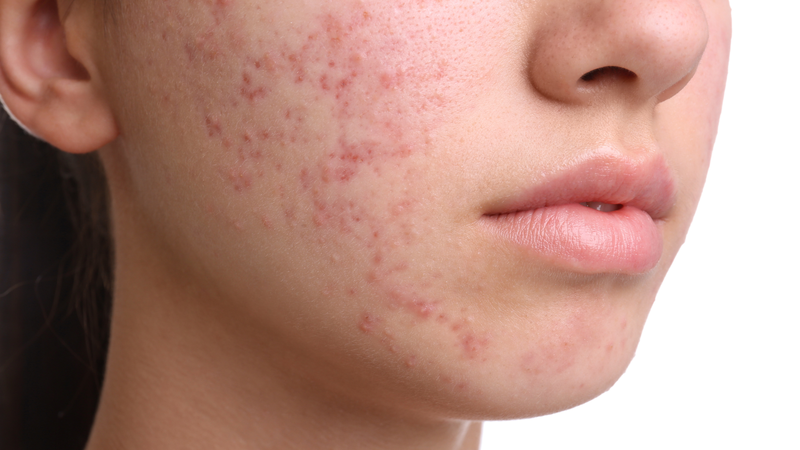 Các bước bổ sung chăm sóc da dầu mụn hàng tuần
