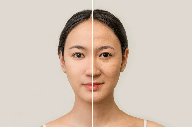 Hai phương pháp nâng cơ mặt đối chiếu về cơ chế và độ xâm lấn
