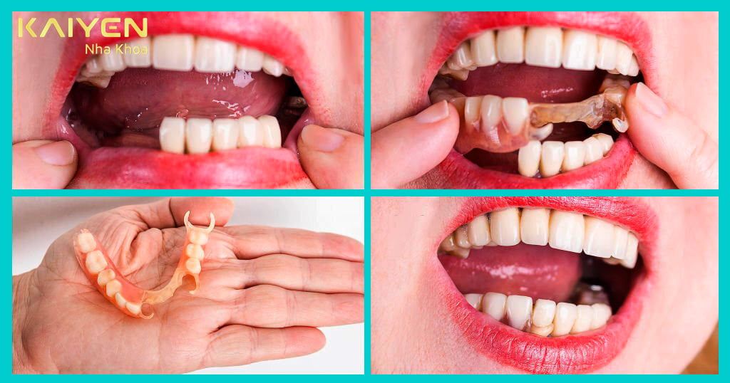 Quy trình độn sụn rãnh cười được thực hiện trong môi trường vô trùng để đảm bảo an toàn tuyệt đối cho khách hàng.