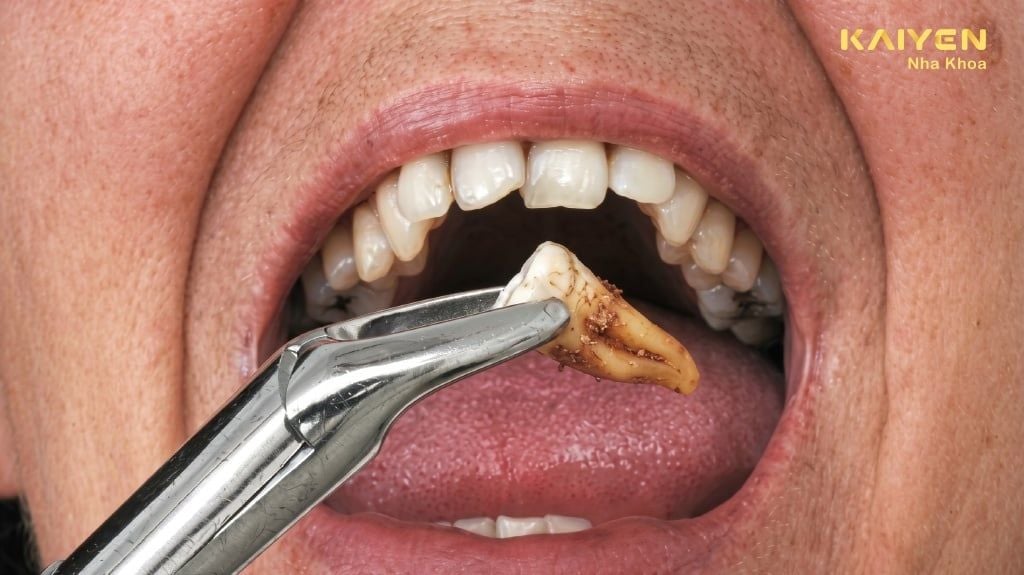 Phân biệt sưng viêm sinh lý và sẹo lồi sau khi thực hiện độn sụn rãnh cười
