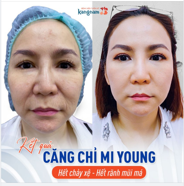 Minh họa căng chỉ trẻ hóa da chuyên sâu