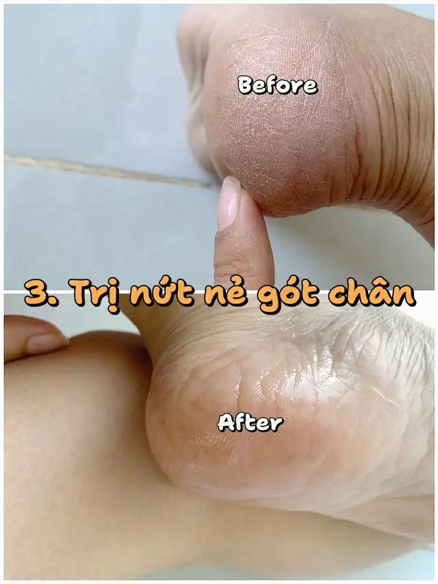 Quy trình triệt lông an toàn bằng công nghệ Diode Laser tại phòng khám thẩm mỹ uy tín Hana.