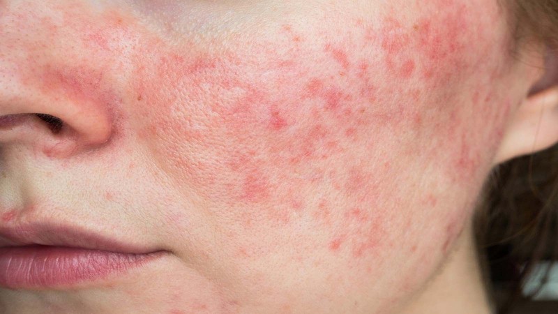 Hình ảnh một phụ nữ đang chạm vào má với làn da khô và nhạy cảm bị kích ứng, cần phục hồi hàng rào bảo vệ da