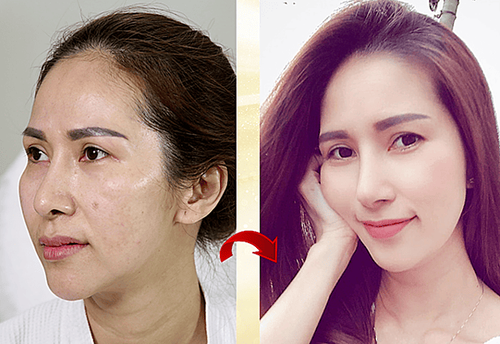 Minh họa các vùng da thực hiện căng da mặt chỉ