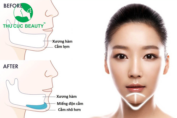 Rút chất liệu độn cằm cũ và chuẩn bị vùng mô mới cho lần độn sụn cằm chính xác hơn