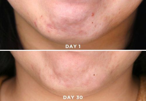 Phục hồi hàng rào bảo vệ da bằng dầu dưỡng và Niacinamide giúp tối ưu hóa hiệu quả GIẢM NHĂN – NÂNG CƠ