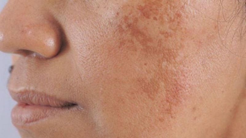 Nám da ảnh hưởng đến sự tự tin khi thực hiện chăm sóc da