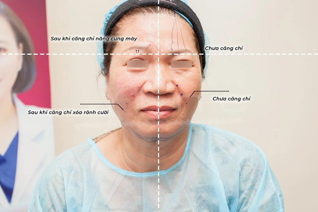 Minh họa cơ chế hoạt động của sợi chỉ sinh học trong quá trình nâng cơ mặt giúp trẻ hóa da mặt không phẫu thuật