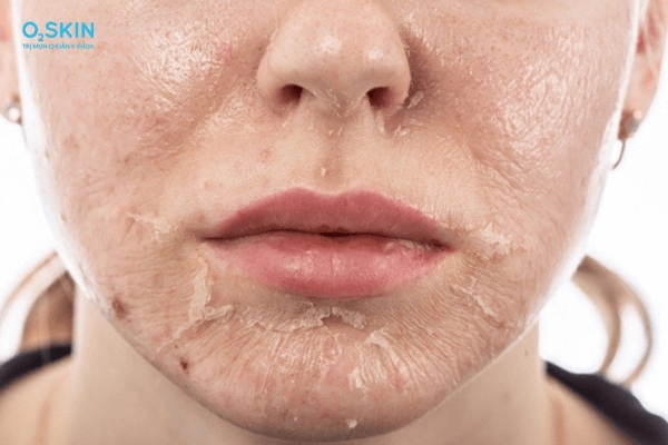 Chế độ ăn giàu vi chất giúp đẩy nhanh quá trình tái tạo cho da sau treatment