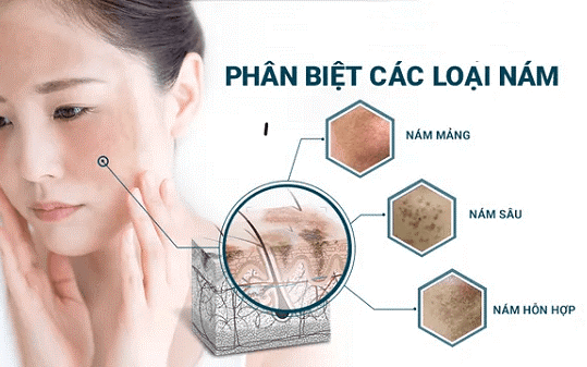 Các giai đoạn phục hồi da sau trị nám ngăn chặn tái phát