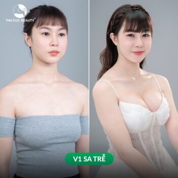 Bác sĩ thẩm mỹ đang tư vấn chi tiết về chi phí nâng ngực an toàn cho khách hàng