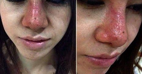 Chăm sóc làn da mụn nhạy cảm vào mùa nắng nóng để giảm viêm