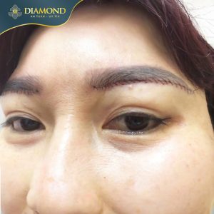 Thời điểm vàng để cắt chỉ sau phẫu thuật nâng cung chân mày
