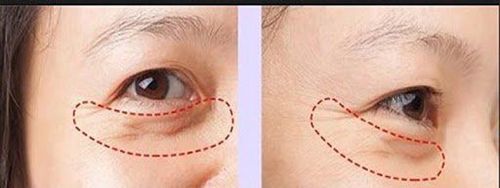 Bác sĩ thực hiện khâu thẩm mỹ bằng chỉ siêu mảnh