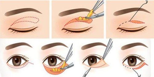 Bác sĩ đang thực hiện kỹ thuật cắt mí mắt dưới với độ chính xác cao