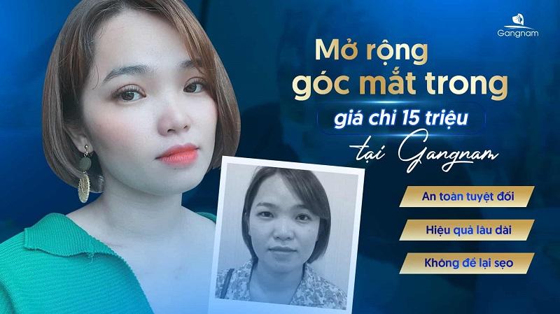 Phẫu thuật thẩm mỹ mắt an toàn giúp thay đổi diện mạo và cải thiện chức năng thị lực