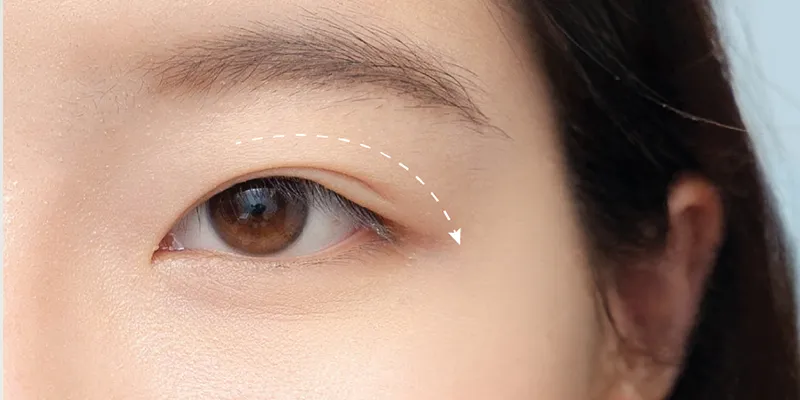 Bác sĩ thăm khám chi tiết cấu trúc vùng mắt trước khi sửa mí