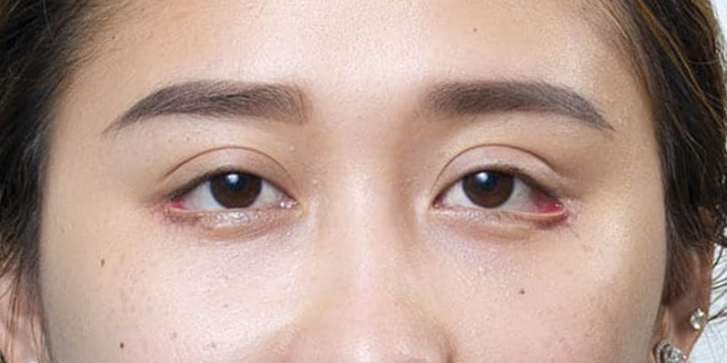 Biến chứng lật mi sau cắt da dư mí dưới cần can thiệp chuyên sâu