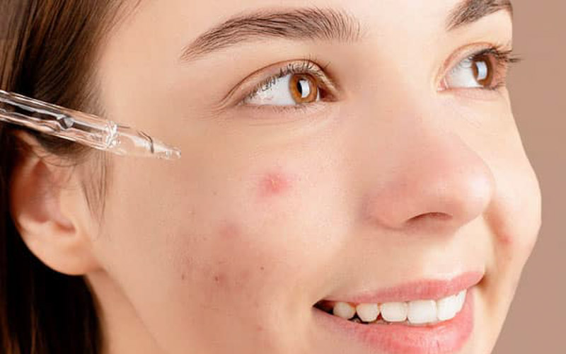 Đánh giá mức độ chịu nhiệt của làn da mụn