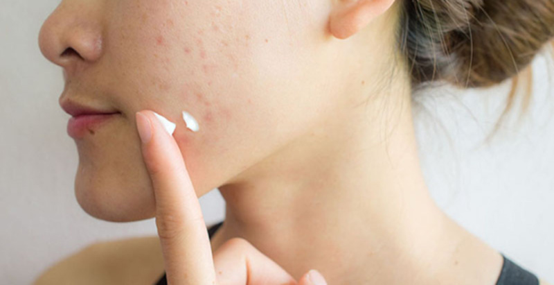 Thoa serum và kem trị mụn đúng cách