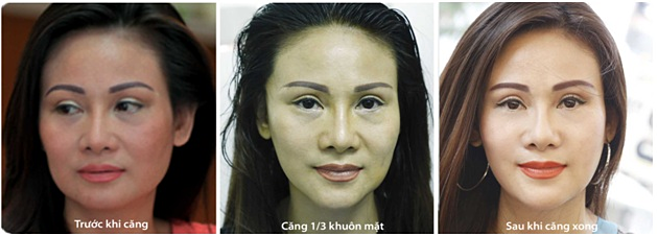 Hướng dẫn chăm sóc vùng da mặt sau khi thực hiện căng chỉ để đảm bảo kết quả an toàn và bền vững.