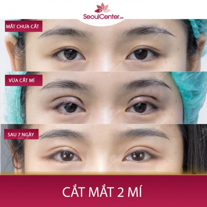 Phòng khám hiện đại với thiết bị y tế đảm bảo quy trình cắt mí an toàn, tránh biến chứng