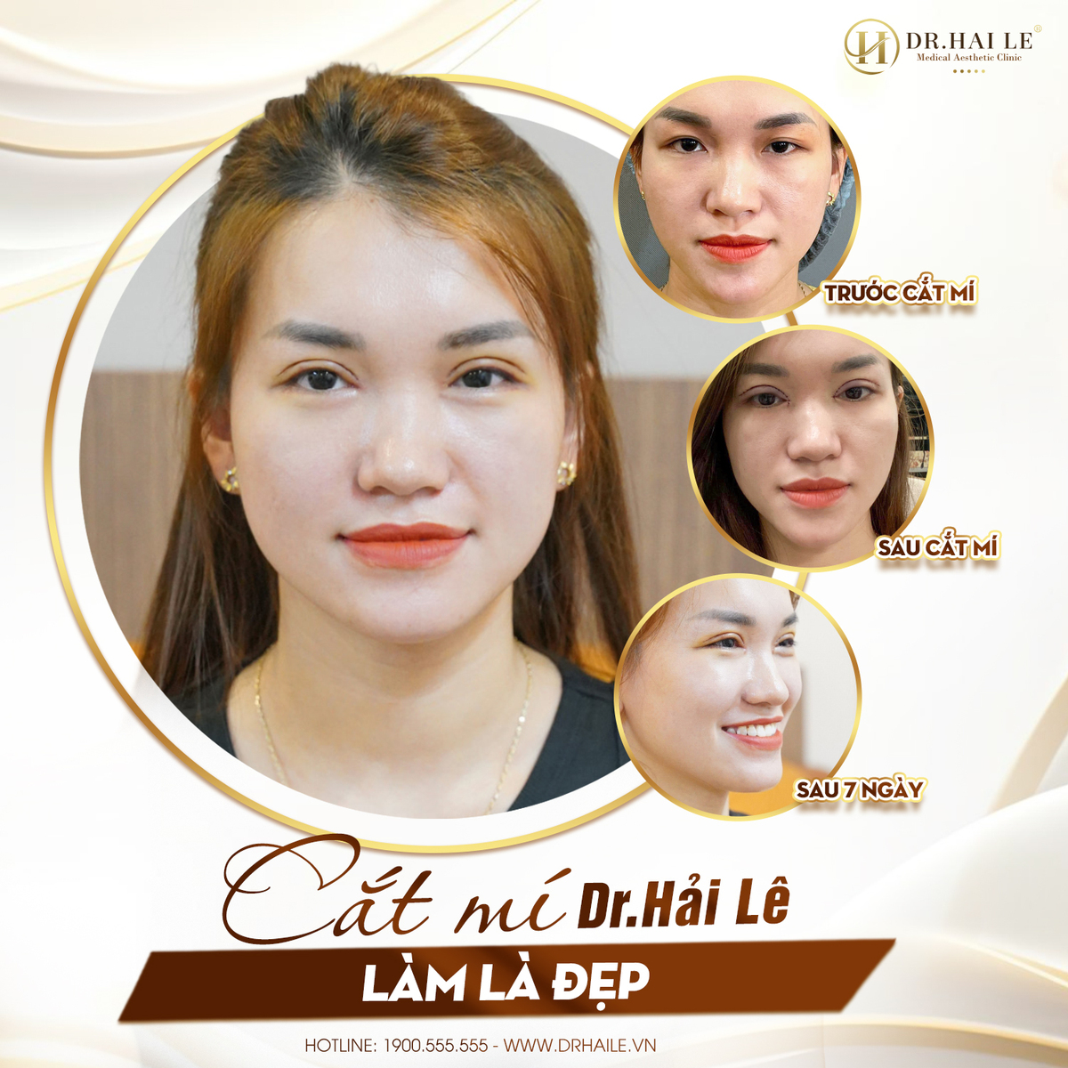 Đôi mắt sau cắt mí, minh họa quá trình phục hồi và tầm quan trọng của việc tự kiểm tra dấu hiệu mí lỗi.