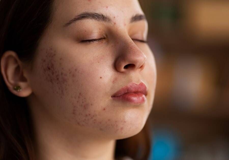 Sử dụng các liệu pháp làm mát giúp giảm sưng viêm mụn hiệu quả