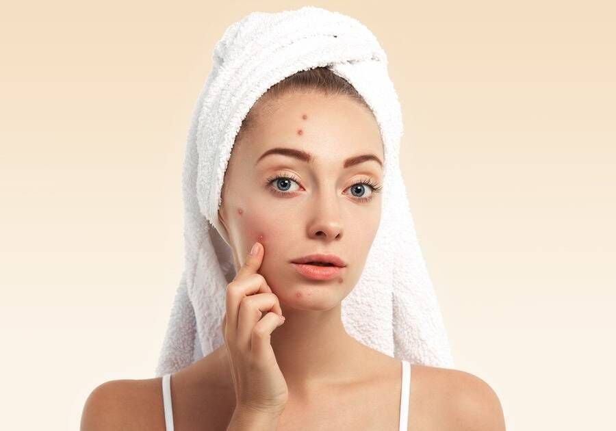 Minh họa các bước chăm sóc da mụn hiệu quả vào mùa nóng