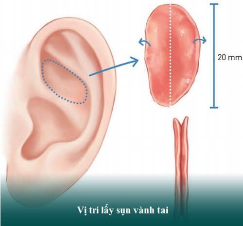 Bác sĩ thực hiện kỹ thuật lấy sụn tai với đường rạch nhỏ
