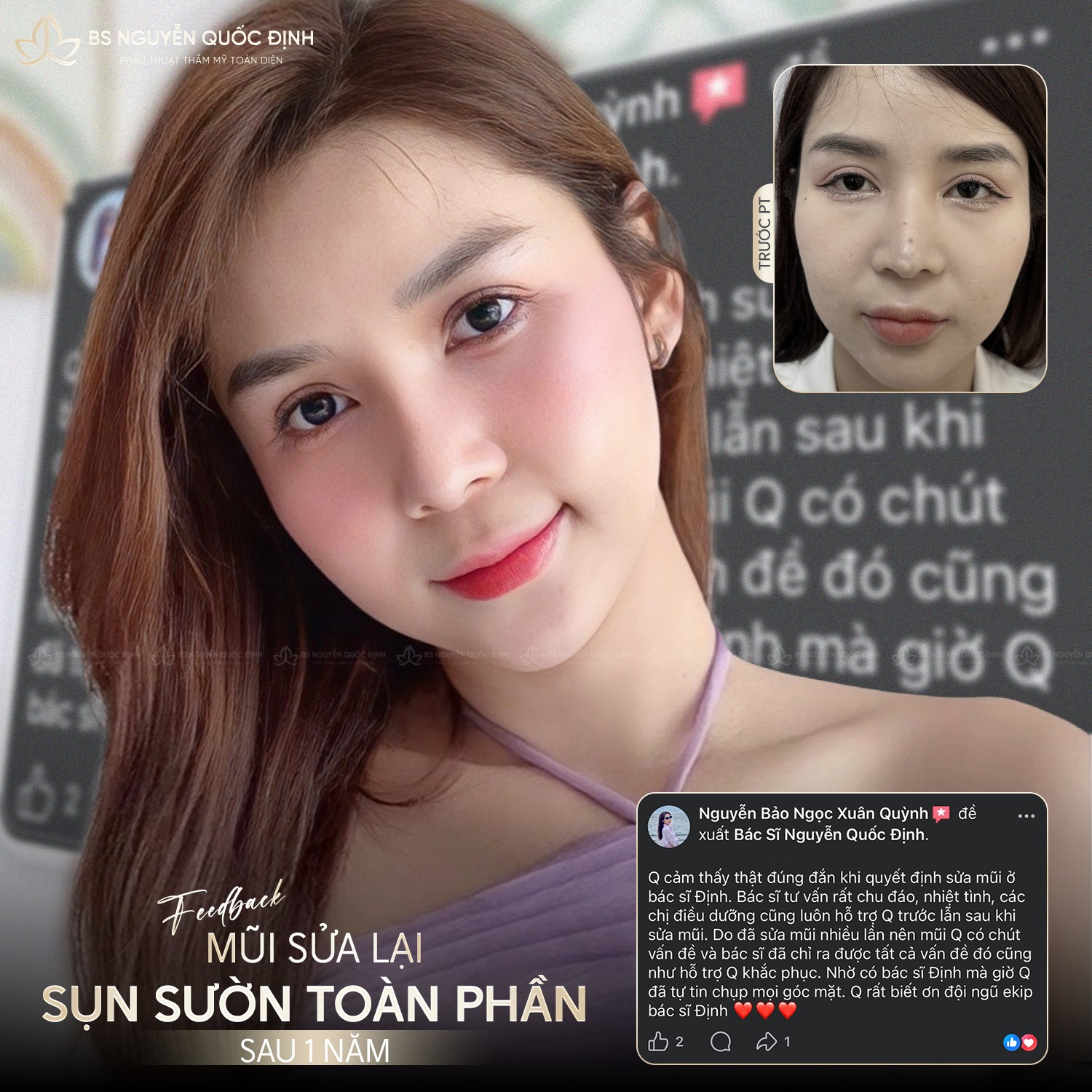 Khách hàng thực hiện quy trình thẩm mỹ chuyên nghiệp tại Hana Premium Beauty Center giúp cải thiện rãnh cười sâu hiệu quả.