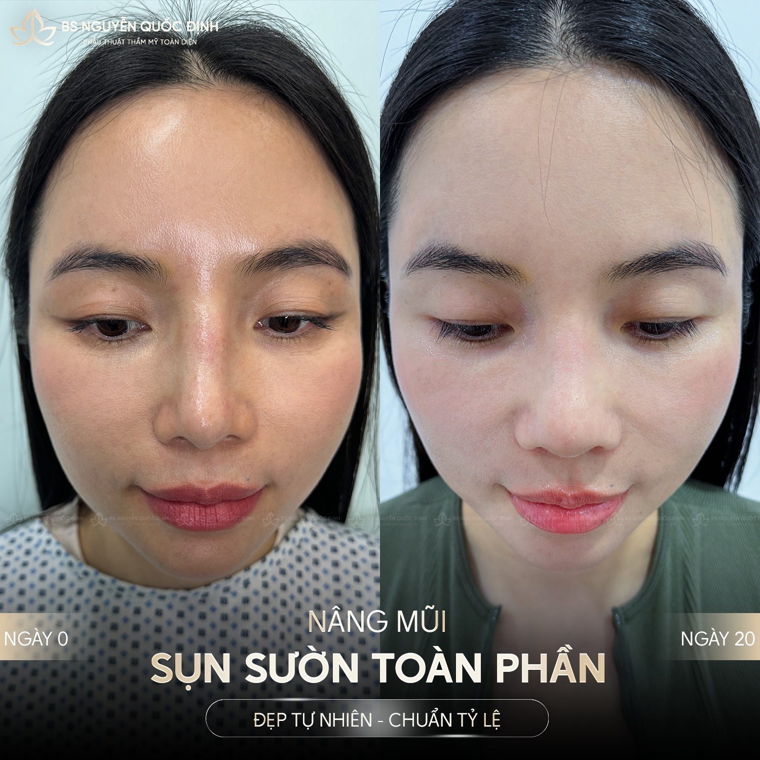Hình ảnh minh họa so sánh các phương pháp trẻ hóa gương mặt rãnh cười sâu