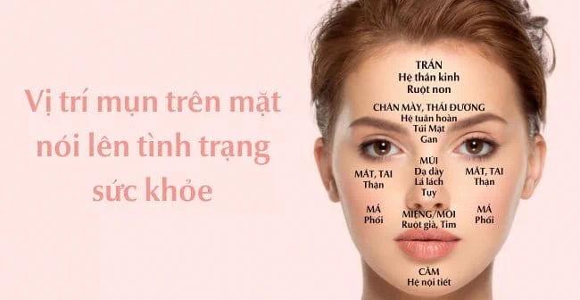 Sơ đồ các vị trí mụn thường gặp trên khuôn mặt