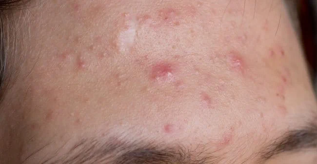 Phân biệt mụn trên trán để chăm sóc da mụn vào mùa nóng hiệu quả