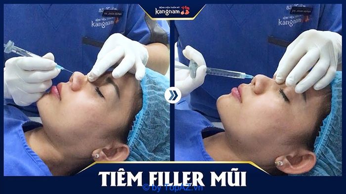 Cách kiểm tra tem phụ trên sản phẩm tiêm filler chính hãng