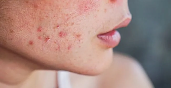 Tình trạng da mặt bị mụn sưng viêm khi thời tiết nóng bức