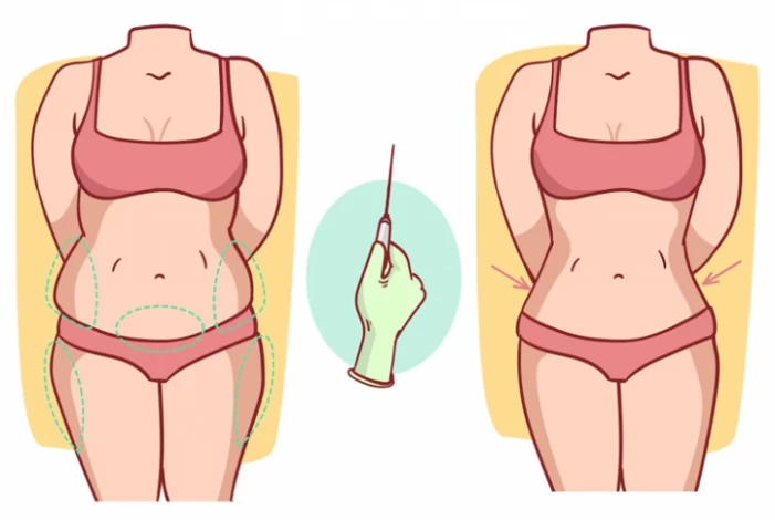 Quy trình phẫu thuật hút mỡ an toàn