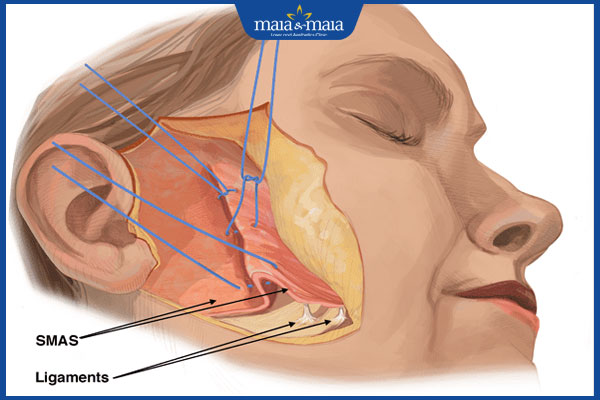 Minh họa sự khác biệt giải phẫu trong kỹ thuật Căng da mặt Deep Plane cho nam giới